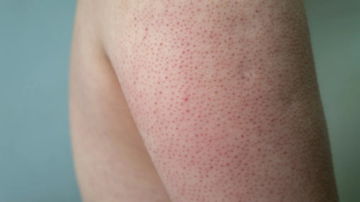 Keratosis Pilaris Causes Symptoms And Treatment Wholistics 7476