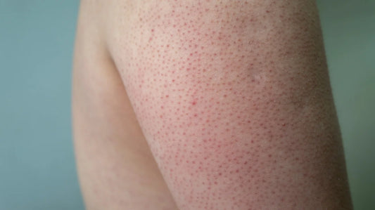 Keratosis Pilaris: Causes, Symptoms, And Treatment